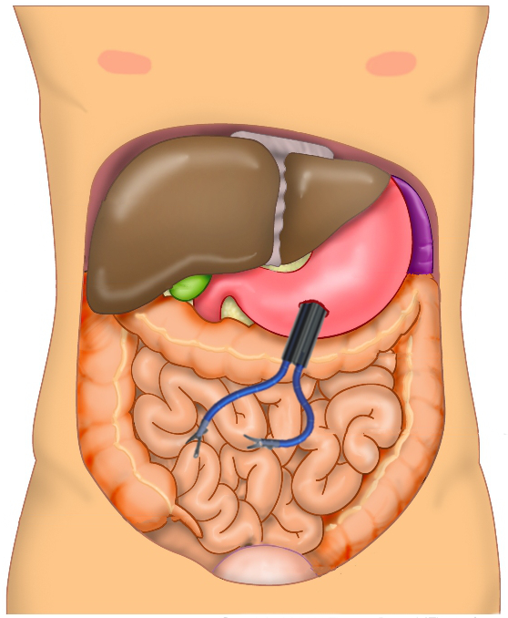 Illustration of the robotic design during a procedure showing access to the abdomen gained through an incision in the stomach wall.